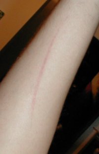Scar 2