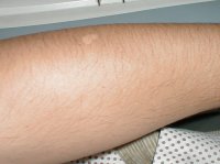 Scar 4